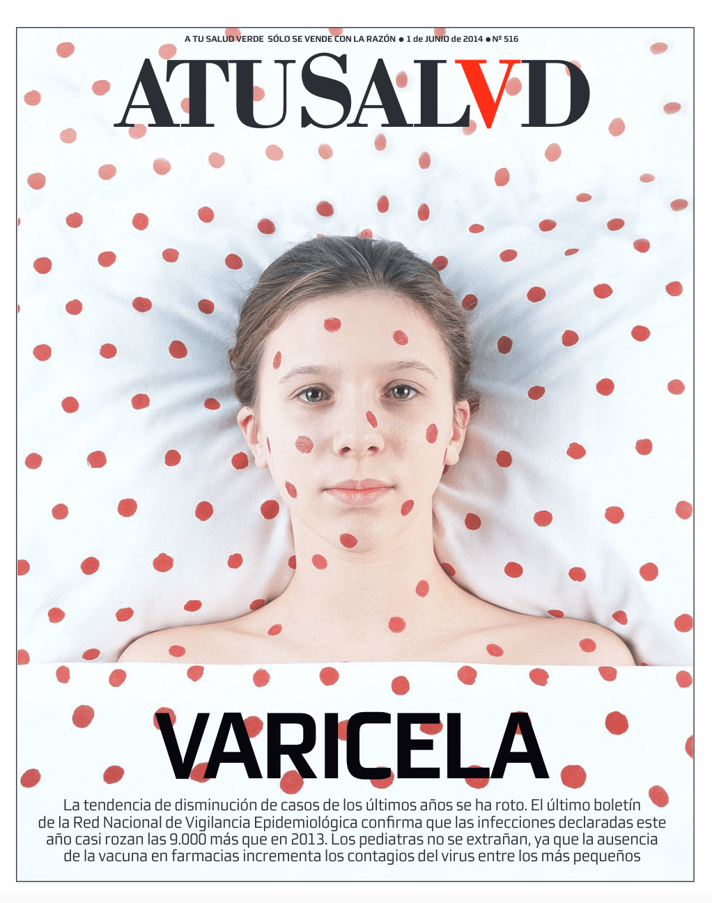 2014: la varicela